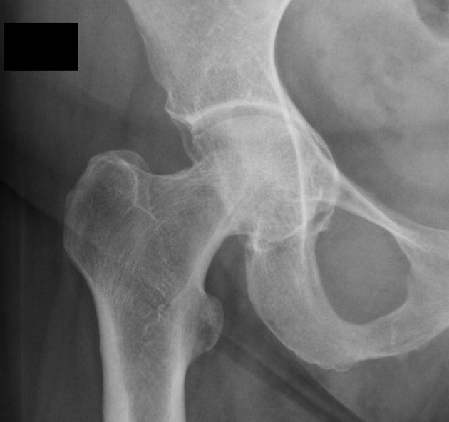 Hình thái Pincer (Kìm) của ổ cối (trong hội chứng kẹt xương đùi-ổ cối)