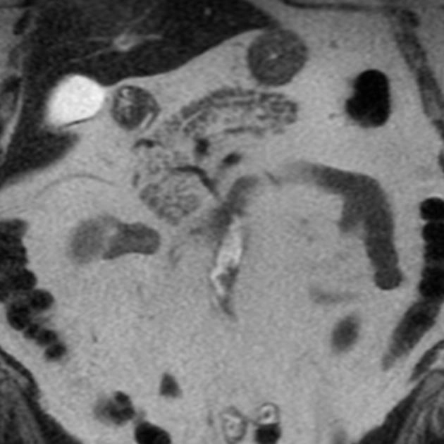 Tụy nhiễm mỡ (Pancreatic Lipomatosis)