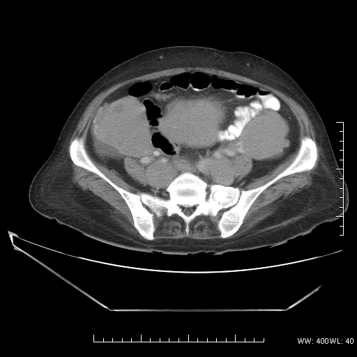 Lymphoma buồng trứng (Ovarian lymphoma)