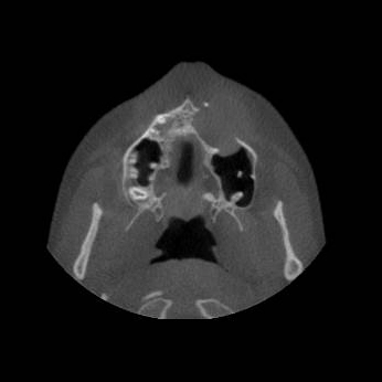U tuyến răng (Adenomatoid odontogenic tumors - AOT)
