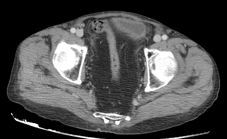 Tích tụ mỡ vùng chậu(Pelvic lipomatosis)
