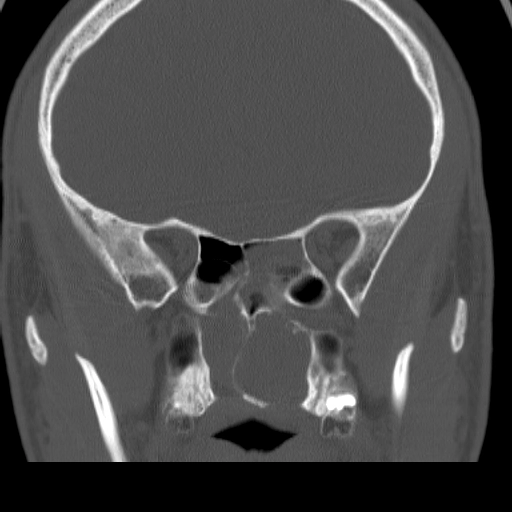 U xơ mạch vòm mũi họng ở tuổi vị thành niên (Juvenile nasopharyngeal angiofibromas - JNA)