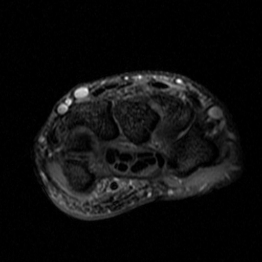 Hội chứng Búa mô út (Hypothenar hammer syndrome)
