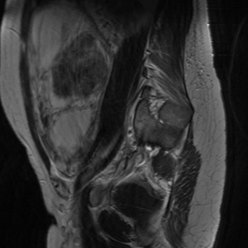 Thoái hóa Đỏ của u xơ tử cung (Red degeneration of a leiomyoma)