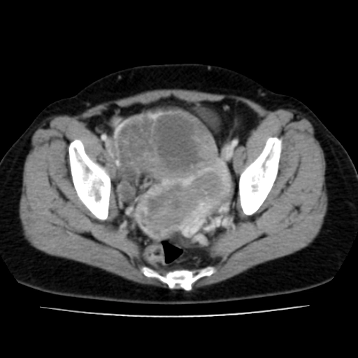 Carcinoma nội mạc tử cung (Endometrial carcinoma)