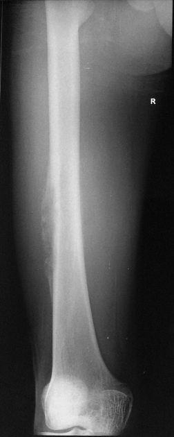 Sarcoma xương cạnh màng xương (Periosteal osteosarcoma) 