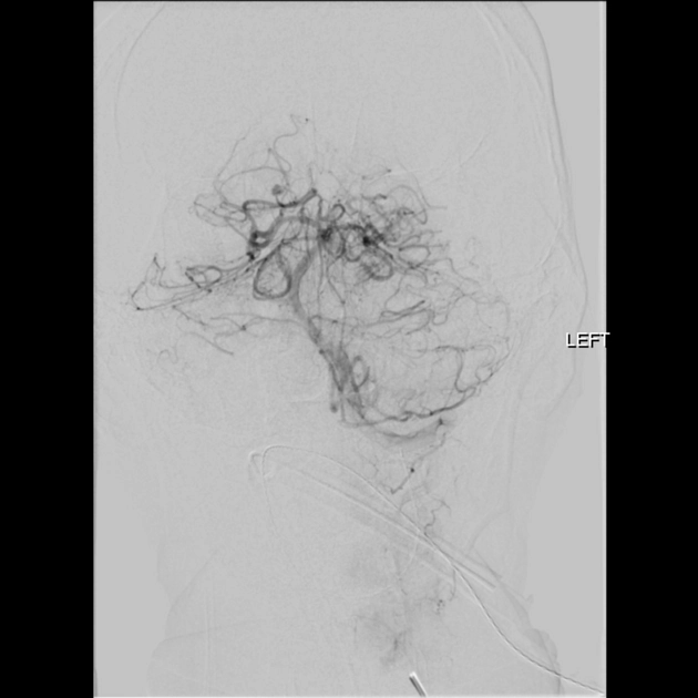 Phình mạch não do nhiễm trùng (Intracranial Mycotic Aneurysm / Intracranial Infectious Aneurysm)