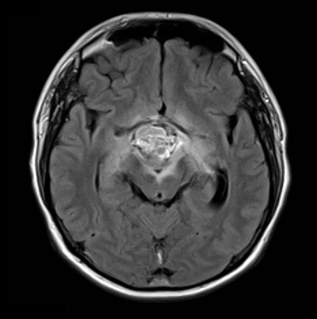 U sọ hầu dạng nhú (Papillary craniopharyngiomas)