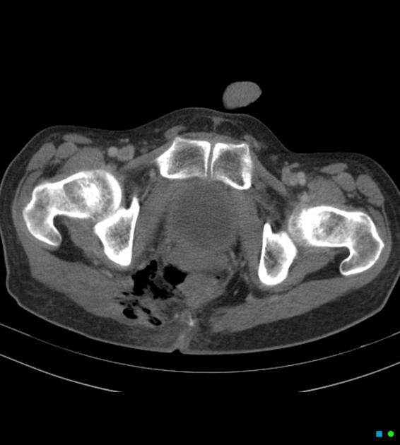 Hoại tử tầng sinh môn Fournier (Fournier gangrene)