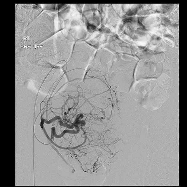 U xơ tử cung (Uterine leiomyoma)
