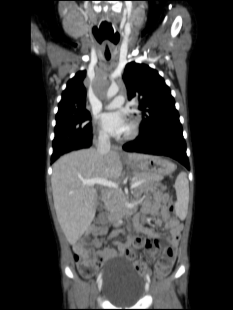 Bệnh Rosai-Dorfman (Rosai-Dorfman Disease - RDD)