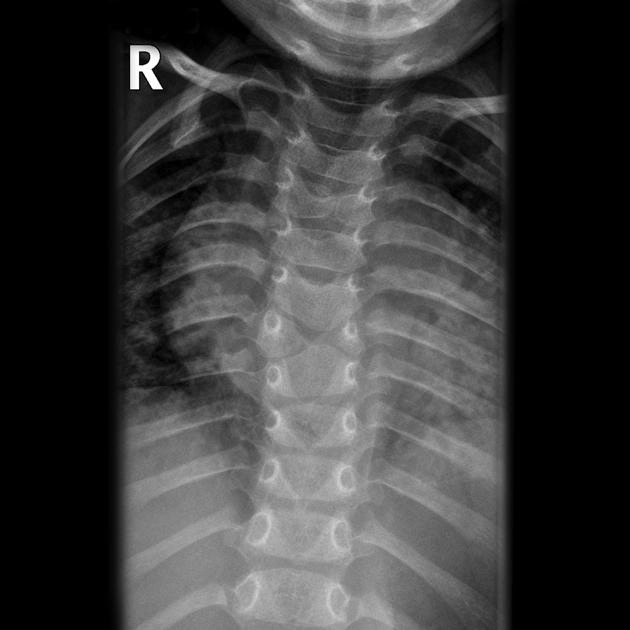 Thân đốt sống hình cánh bướm (Butterfly vertebra)