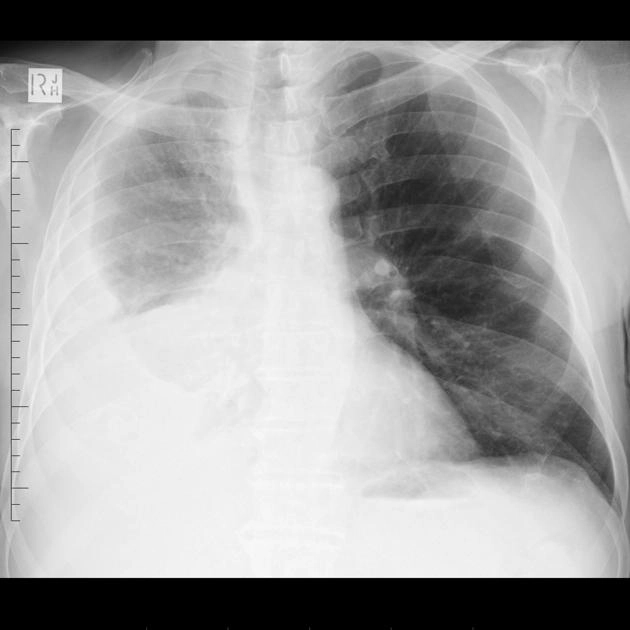 Hệ thống phân giai đoạn TNM lần thứ tám cho U trung biểu mô màng phổi ác tính - Malignant pleural mesothelioma (TNM staging)