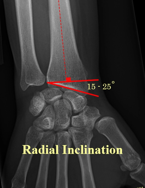 Độ nghiêng xương quay (Radial inclination)