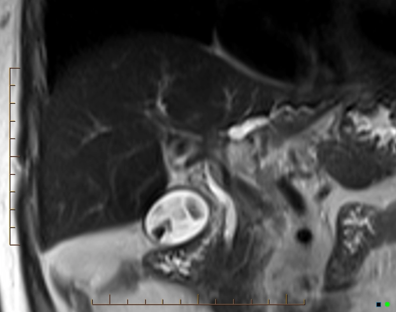 U Klatskin (Ung thư đường mật vùng rốn gan)