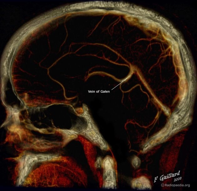 Phân loại Yasargil cho dị dạng phình tĩnh mạch Galen (Yasargil classification of vein of Galen aneurysmal malformations)