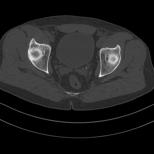 Khuyết phụ trên ổ cối (Accessory superior acetabular notch)