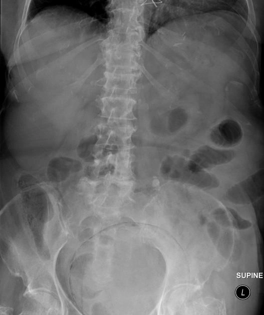 Viêm bàng quang sinh hơi (Emphysematous cystitis)