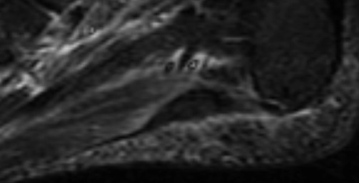 Viêm cân gan bàn chân (Plantar fasciitis)