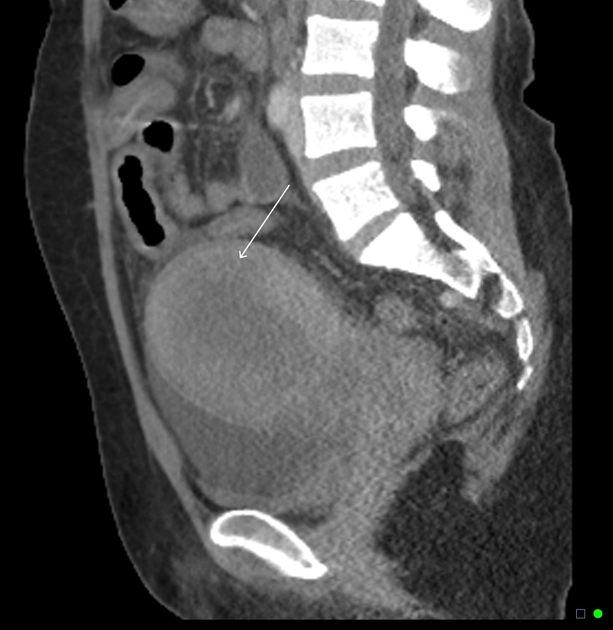 Ứ mủ buồng tử cung (Pyometrium)