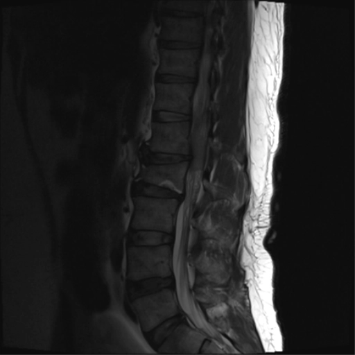 Khối u tân sinh trong màng cứng-ngoài tủy (Intradural extramedullary neoplasms)