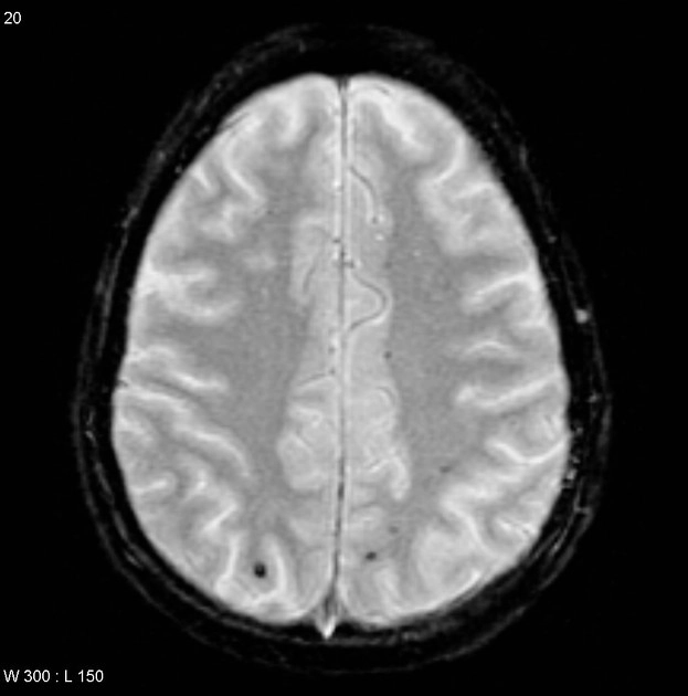 Phân độ tổn thương sợi trục lan tỏa(Diffuse Axonal Injury Grading)