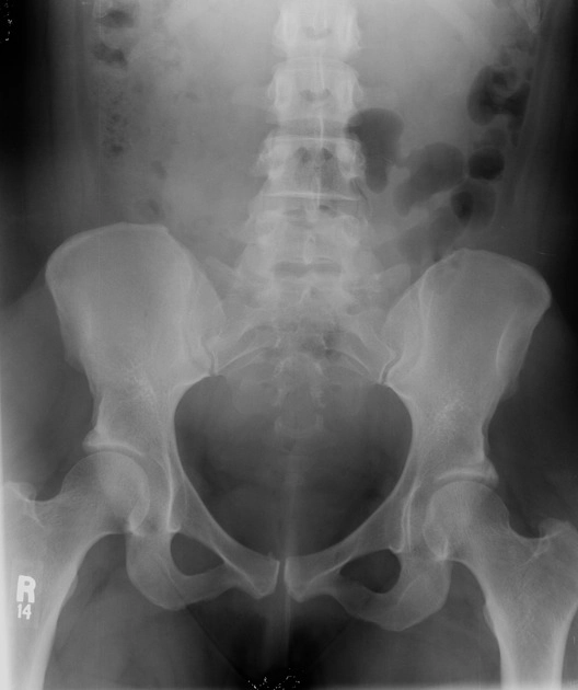 Túi thừa niệu đạo (Urethral diverticulum)