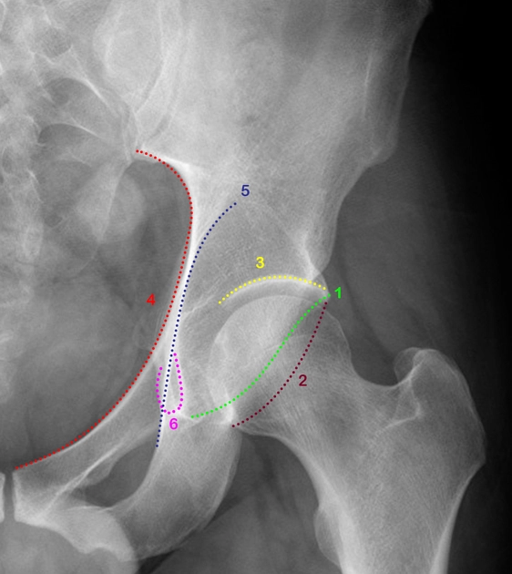 Gãy ổ cối (Acetabular fracture)