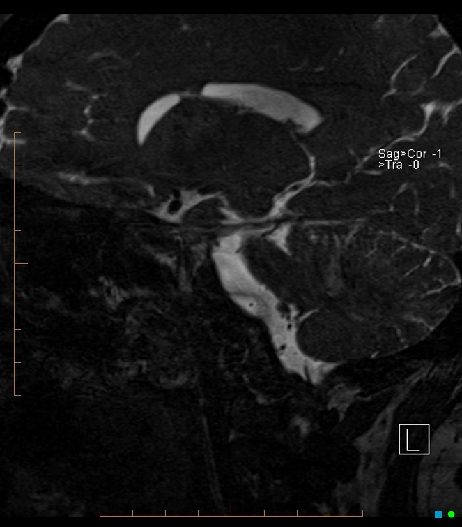 Tổn thương lạc chỗ dây sống dạng bọng (Ecchordosis physaliphora)