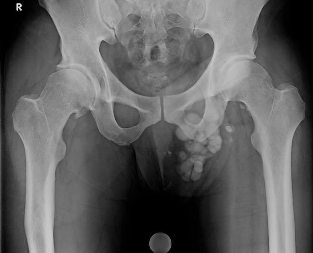 Vôi hóa bìu vô căn (Idiopathic scrotal calcinosis)