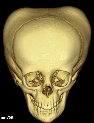 Tụ máu dưới màng xương (Cephalohematoma/subperiosteal hematoma)