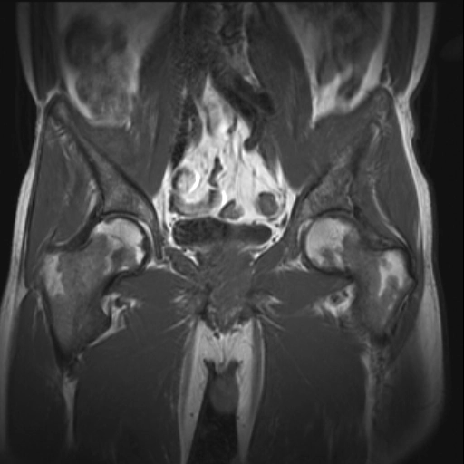 Chuyển dạng ngược tủy xương (Bone marrow reconversion)