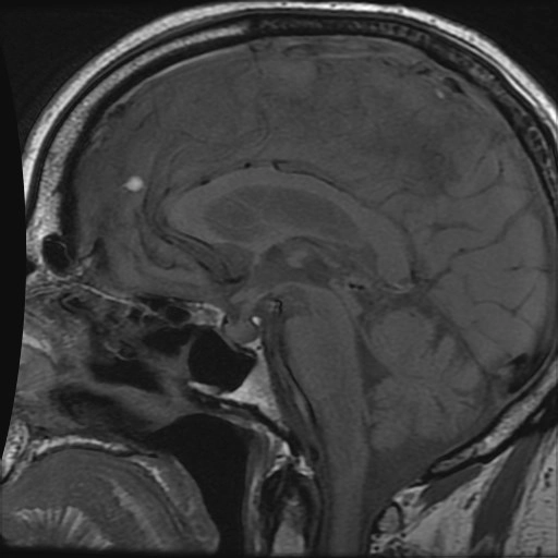 Viêm tuyến yên liên quan đến IgG4 (IgG4-related hypophysitis)