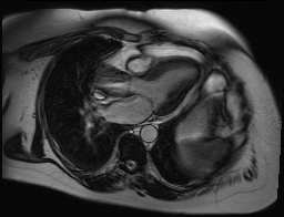 Hẹp van động mạch chủ (Aortic valve stenosis)