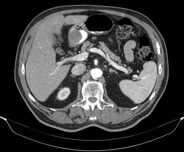 U cơ trơn dạ dày (Gastric leiomyoma)