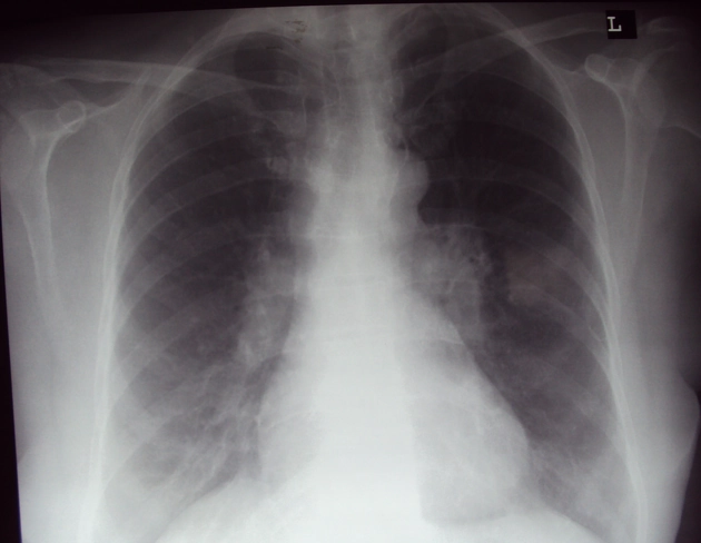 Tổn thương cơ xương khớp của bệnh Sarcoidosis