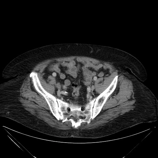 Viêm bao hoạt dịch cơ thắt lưng chậu (Iliopsoas bursitis)