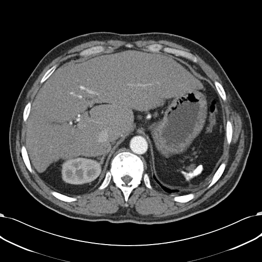 Teo lách (Autosplenectomy)