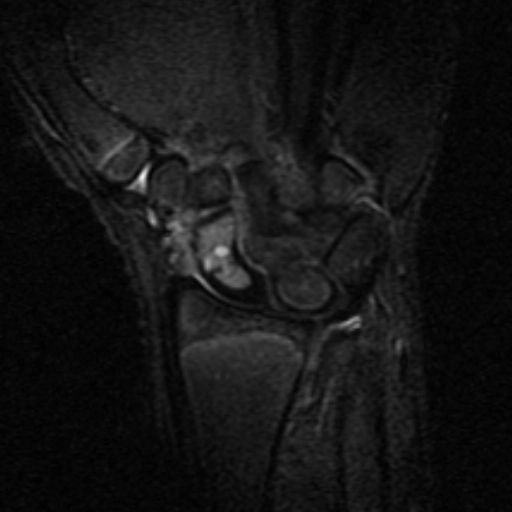 hoại tử vô mạch xương thuyền (Osteonecrosis of the scaphoid bone)