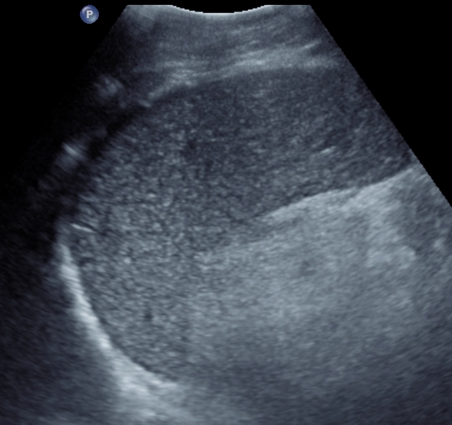 Nốt lắng đọng sắt ở lách (Splenic siderotic nodules)