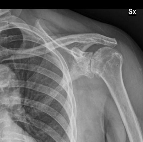 Thoái hóa khớp Ổ Chảo - Cánh Tay (Glenohumeral Osteoarthritis)
