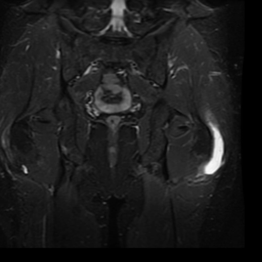 Viêm bao hoạt dịch mấu chuyển lớn (Trochanteric bursitis)