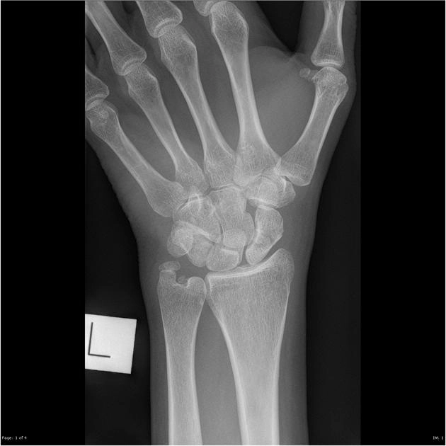 Biến dạng lưng gù của xương thuyền (Humpback deformity of the scaphoid)