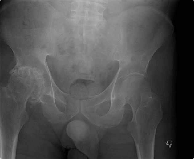 Thoái hóa khớp sau chấn thương (Post-traumatic Osteoarthritis - PTOA)