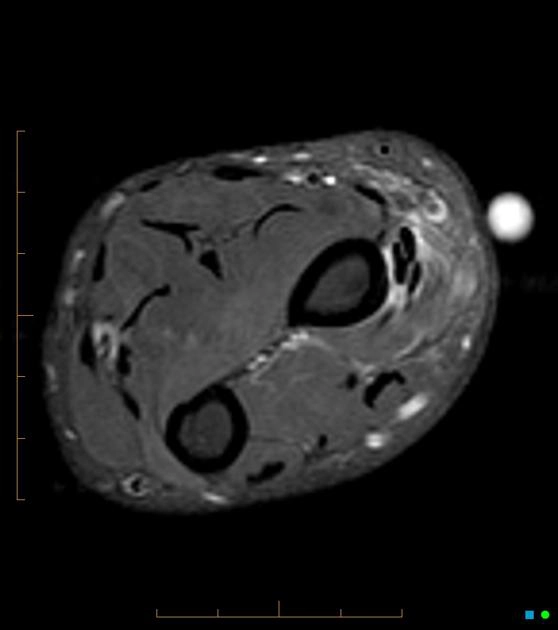 Hội chứng giao thoa gân duỗi gần (Proximal intersection syndrome)