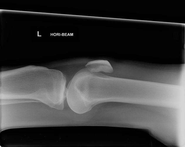 Bong tách sụn khớp gối (Chondral delamination)
