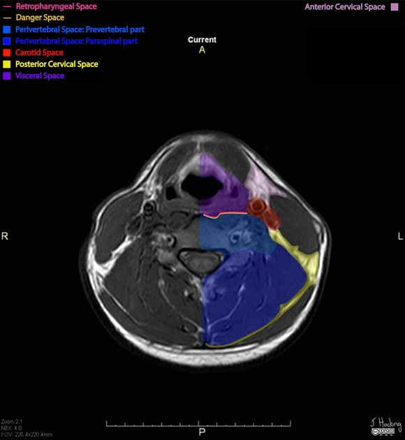 Khoang tạng ở cổ (Visceral space)