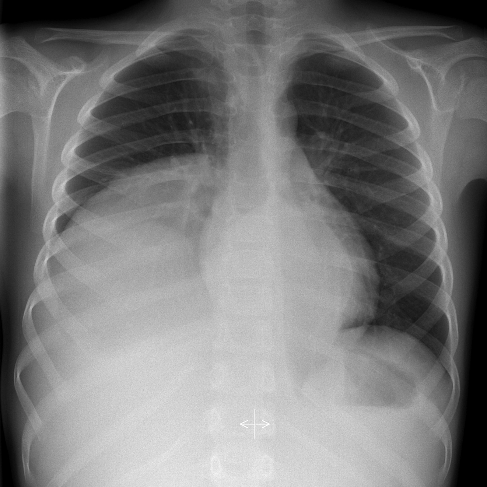 Khối choán chỗ trung thất sau (Posterior Mediastinal Mass)