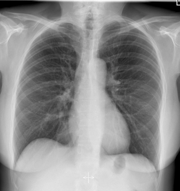 X-quang ngực thẳng bình thường (Chest Radiograph) 