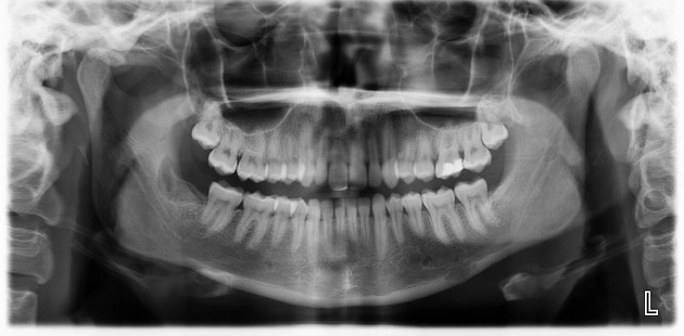 Tổn thương tế bào khổng lồ trung tâm (Central giant cell lesions granuloma)